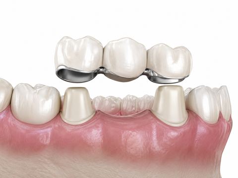 Coronas y puentes dentales en Tijuana — Dr. Rodolfo Castro