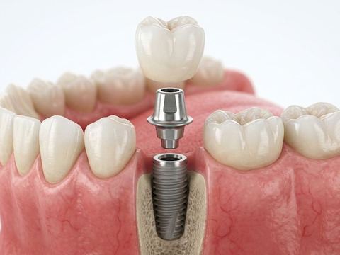 Dental implants in Tijuana — Dr. Rodolfo Castro dental office